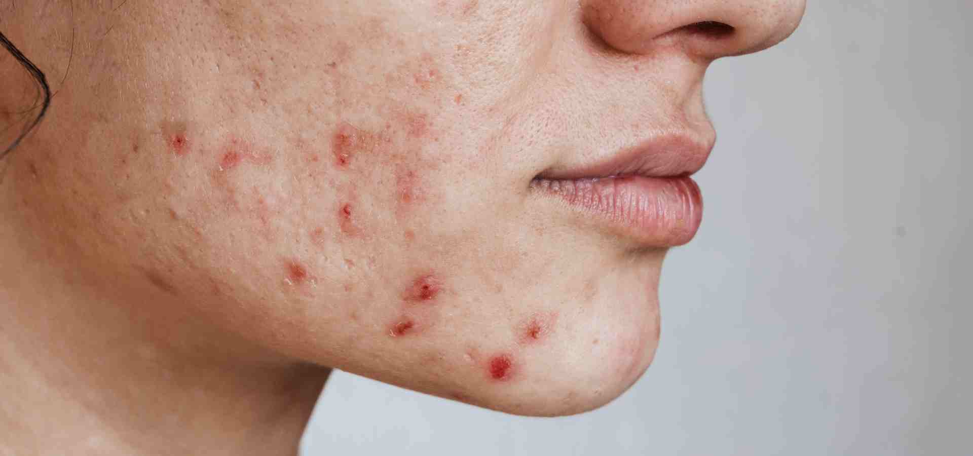 Acne: Sintomas, Causas e Opções de Tratamento